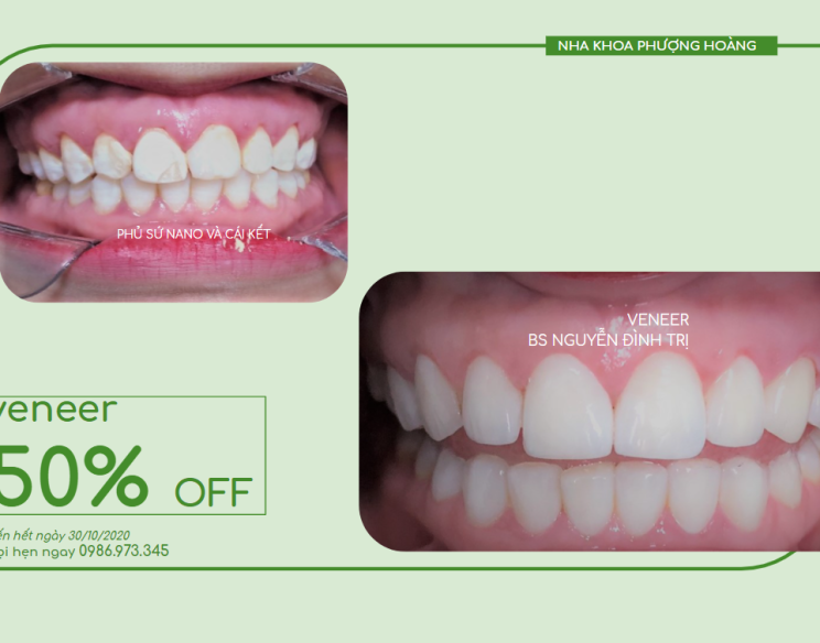 MẶT DÁN SỨ VENEER THẨM MỸ